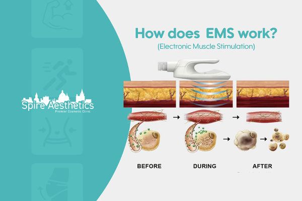 EMS treatment for post pregnancy weight loss treatment Blackpool
