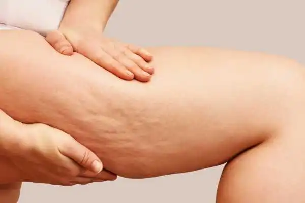 Image of woman showing leg with cellulite Blackpool