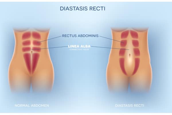 What Non-Surgical Options Are Available for Diastasis Recti Blackpool?