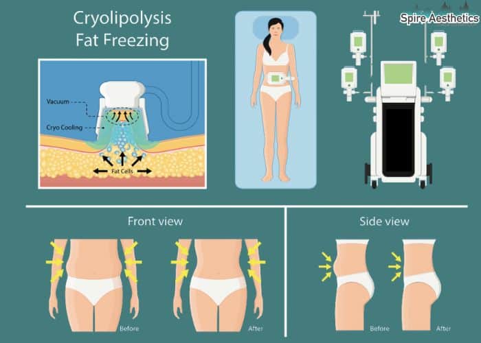 Image of diet and fat freezing combined for best results for Spire Aesthetics Blackpool