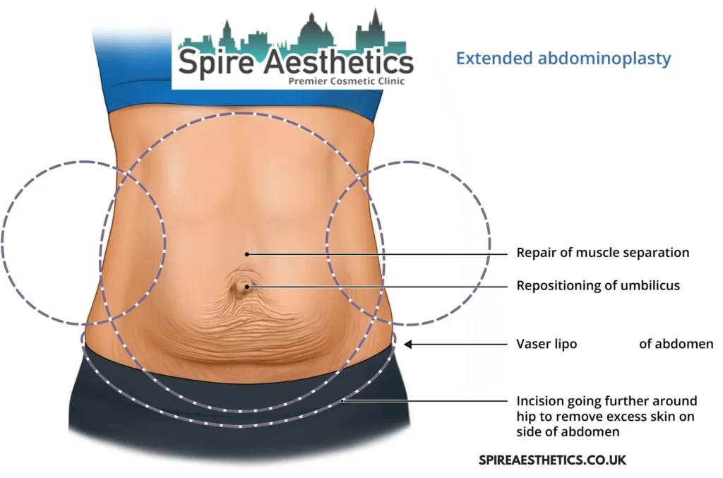 Understanding Loose Skin After Gastric Band Blackpool Surgery and HIFU Treatment