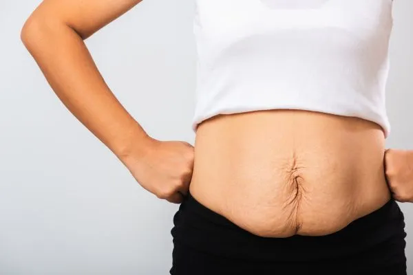 Image of a woman's stomach after weight loss with sagging skin following a gastric band Blackpool
