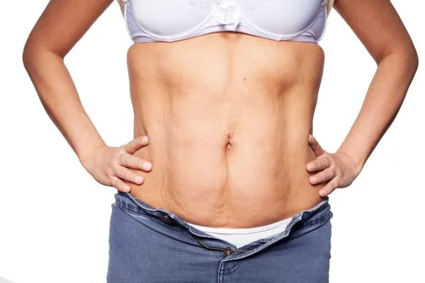 sagging skin on woman's stomach after weight loss injections Blackpool