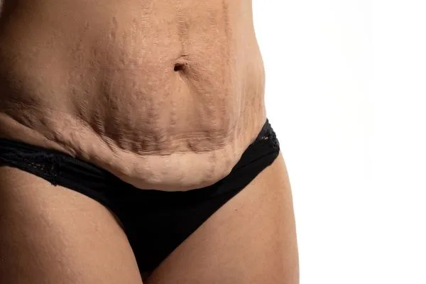 Image of womans stomach after weight loss injections Blackpool showing saggy skin