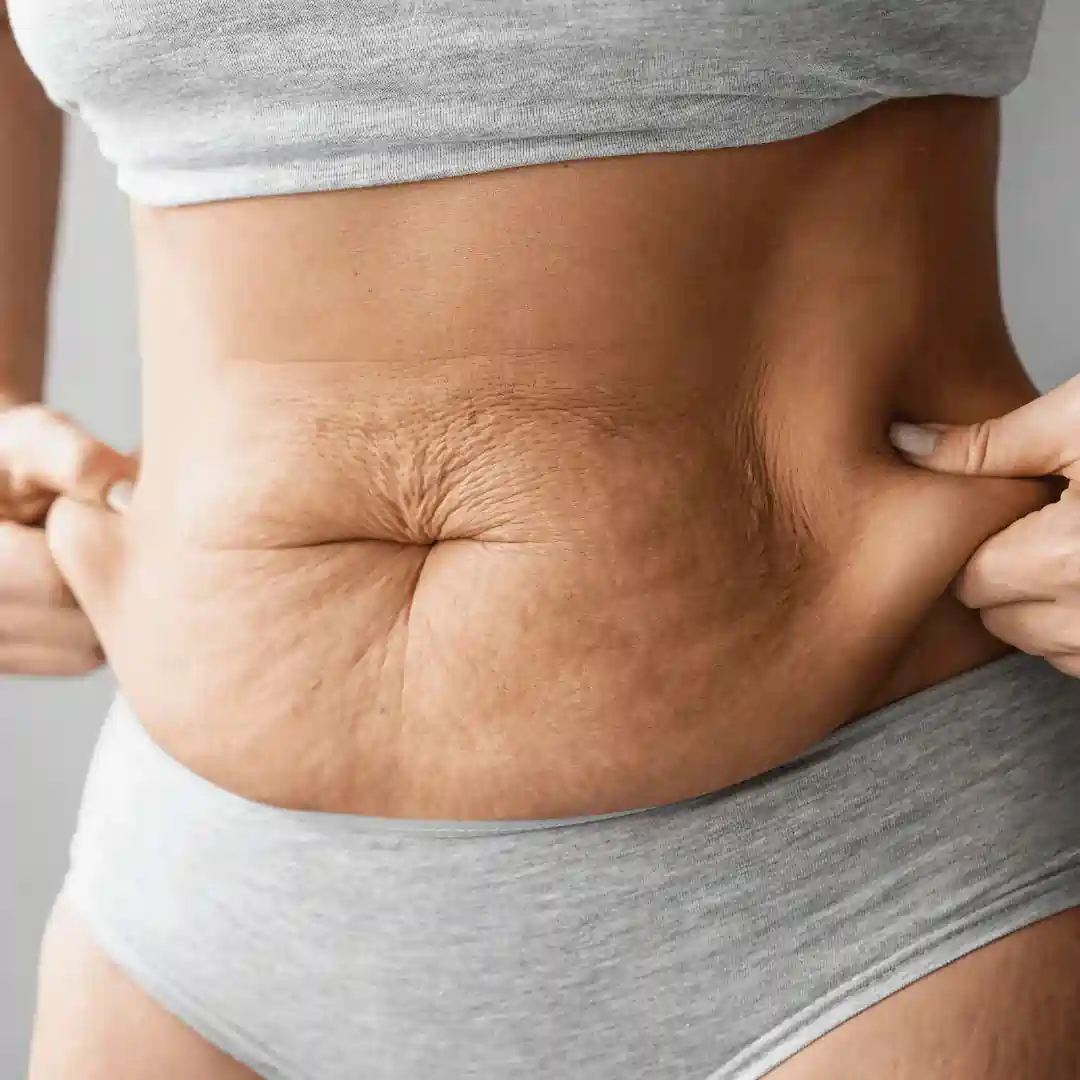 Is It Normal to Have Loose Skin After Pregnancy Blackpool?