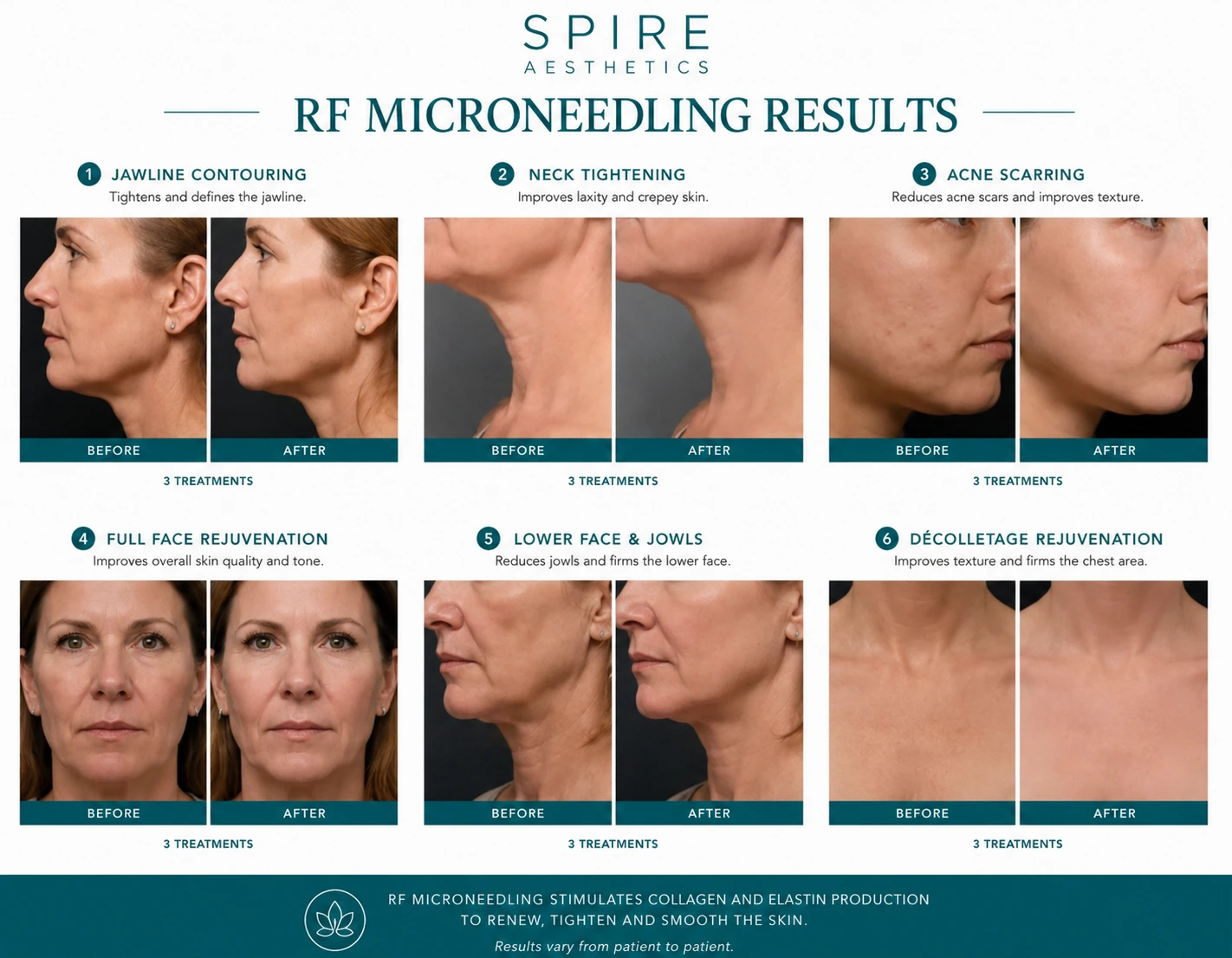 RF Microneedling Skin tightening Blackpool results