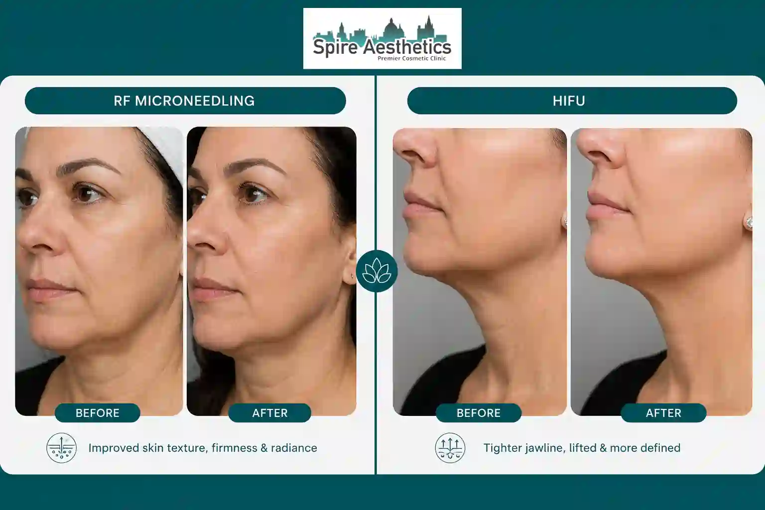 Can RF Microneedling and HIFU Be Combined Blackpool?