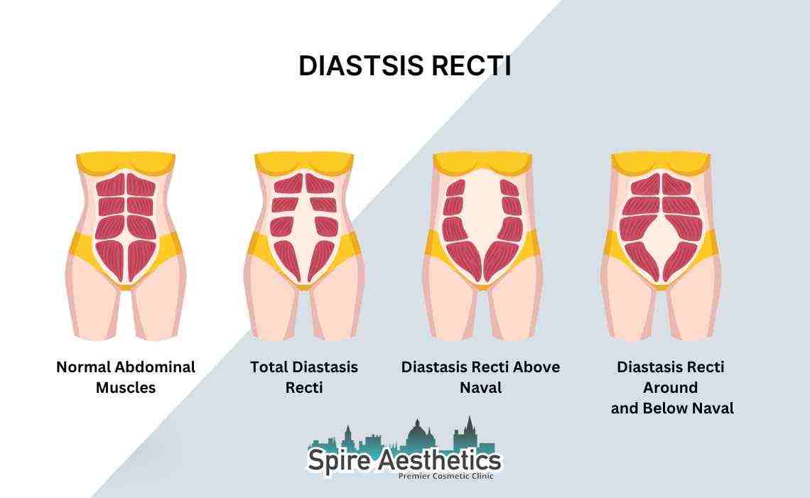 Is Non-Surgical Diastasis Recti Treatment Right for You? Common Concerns Answered Blackpool